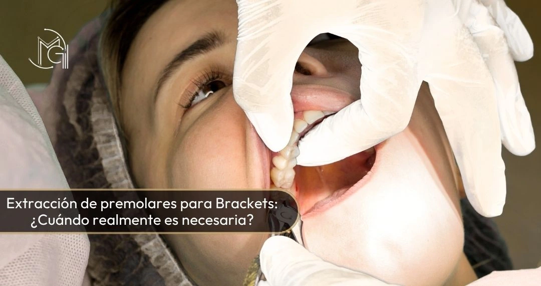 Extracción de premolares para Brackets cuándo realmente es necesaria - Dra Carolina Gil