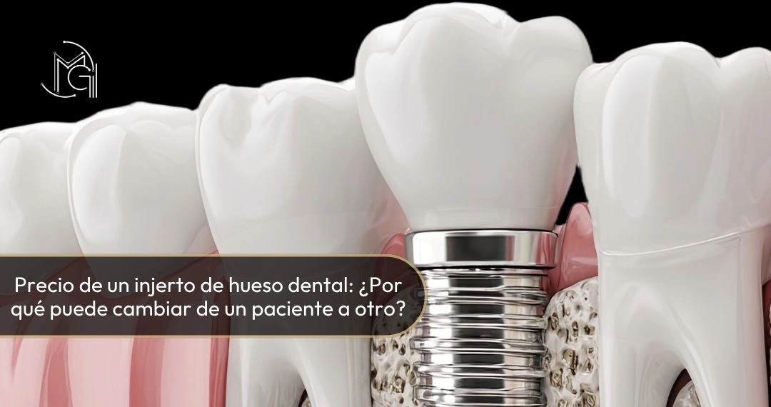 Precio de un injerto de hueso dental por qué puede cambiar de un paciente a otro - Dra. Carolina Gil